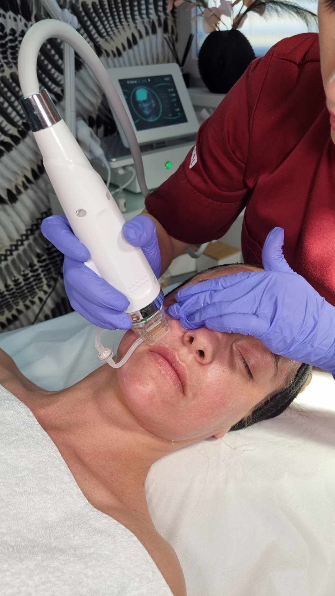 Radiofrekvenčni microneedling – fotografija 2, ESTETICAL Koper