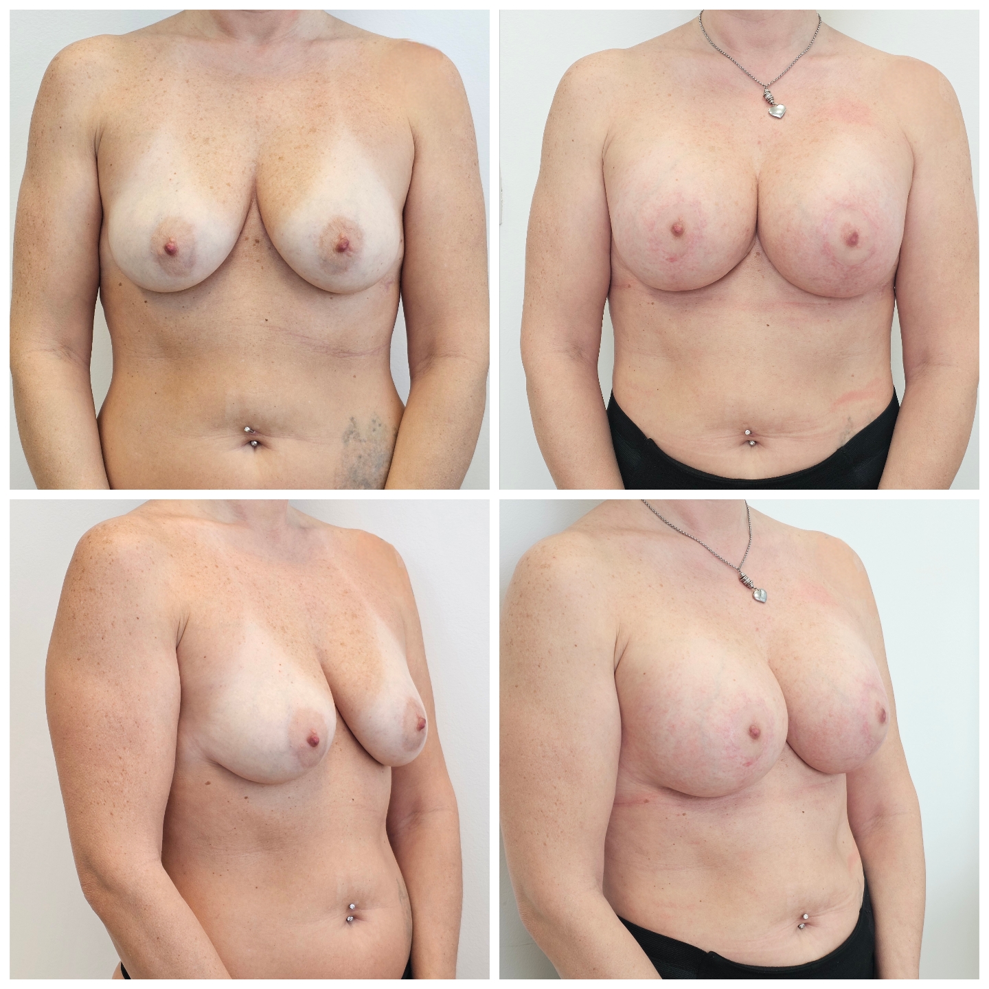 Prej in po posegu – Preobrazba mamic (Mommy Makeover), rezultat 1 (ESTETICAL Koper)