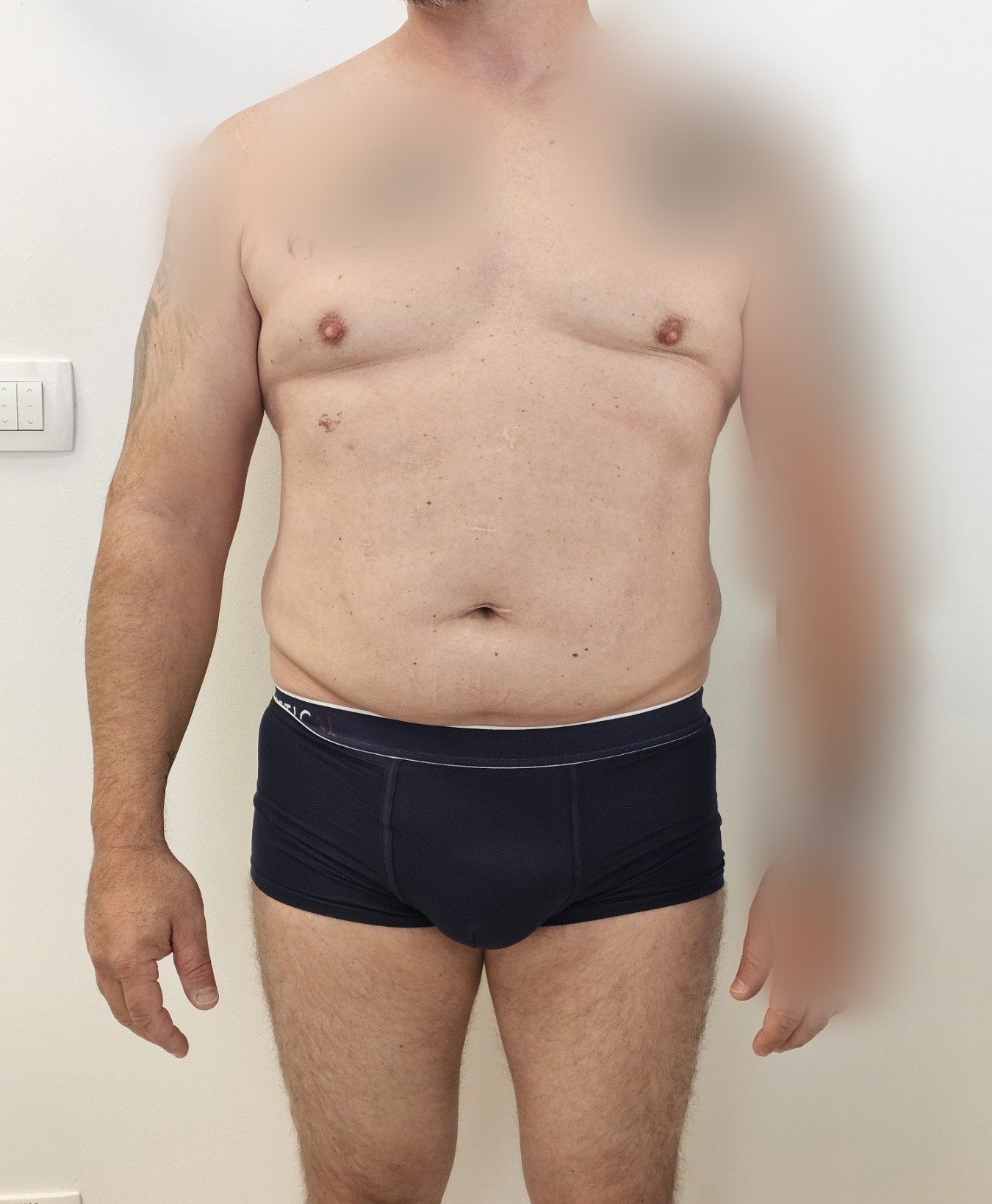 Prej in po posegu – Liposukcija, rezultat 9 (ESTETICAL Koper)
