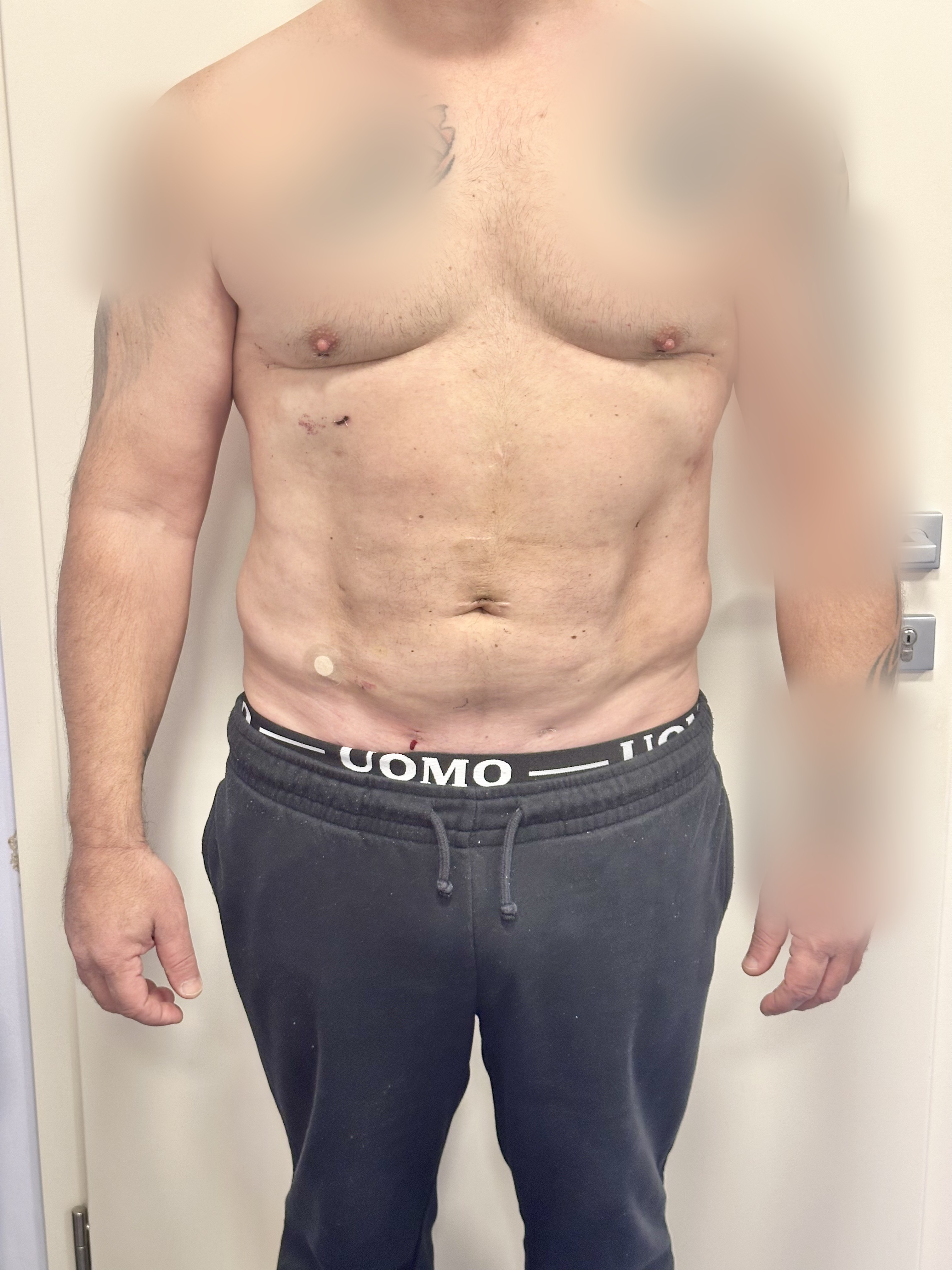 Prej in po posegu – Liposukcija, rezultat 7 (ESTETICAL Koper)
