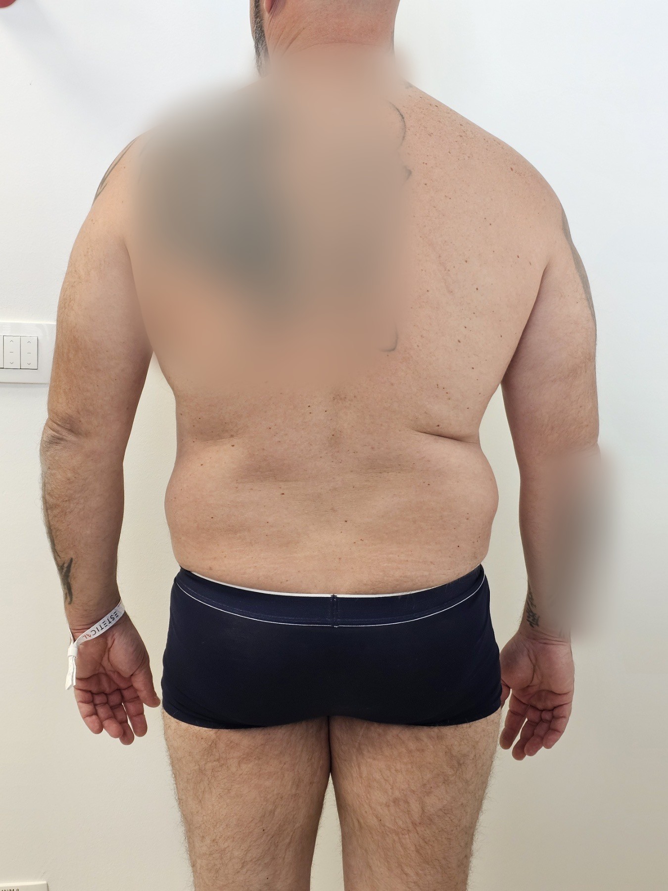 Prej in po posegu – Liposukcija, rezultat 10 (ESTETICAL Koper)