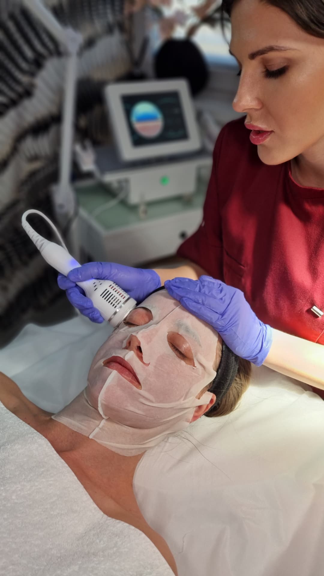 Radiofrekvenčni microneedling – fotografija 4, ESTETICAL Koper
