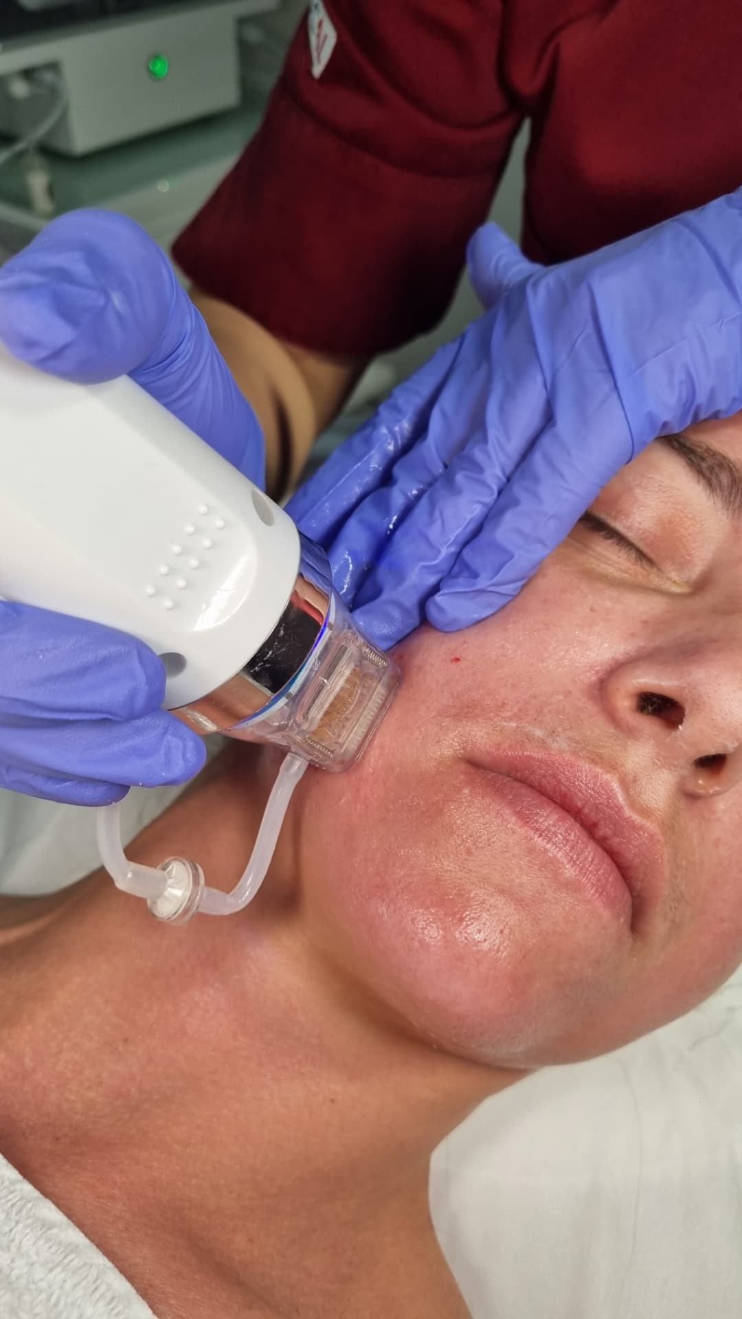 Radiofrekvenčni microneedling – fotografija 3, ESTETICAL Koper