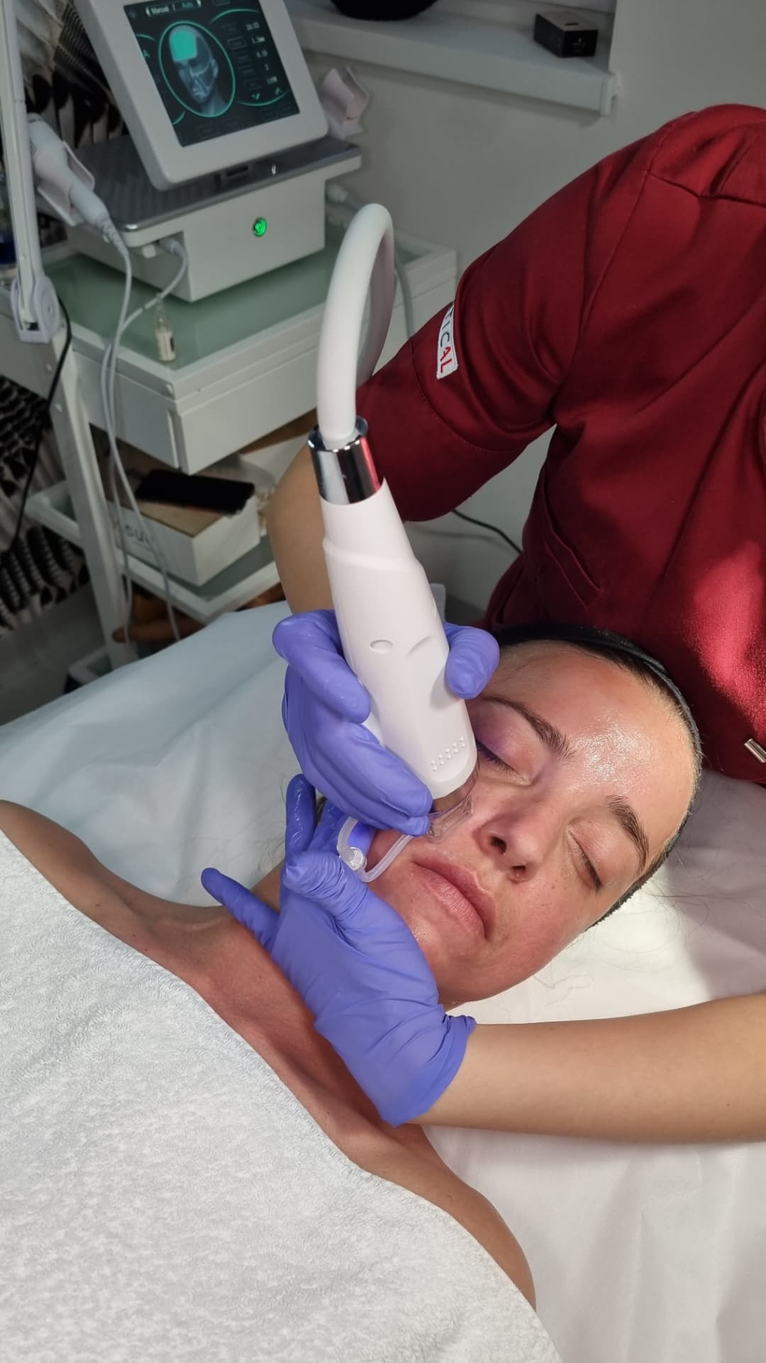 Radiofrekvenčni microneedling, ESTETICAL Koper
