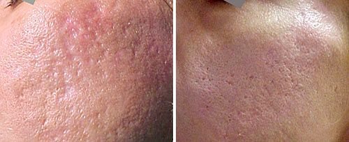 Brazgotine po aknah – pred in po laserskem zdravljenju