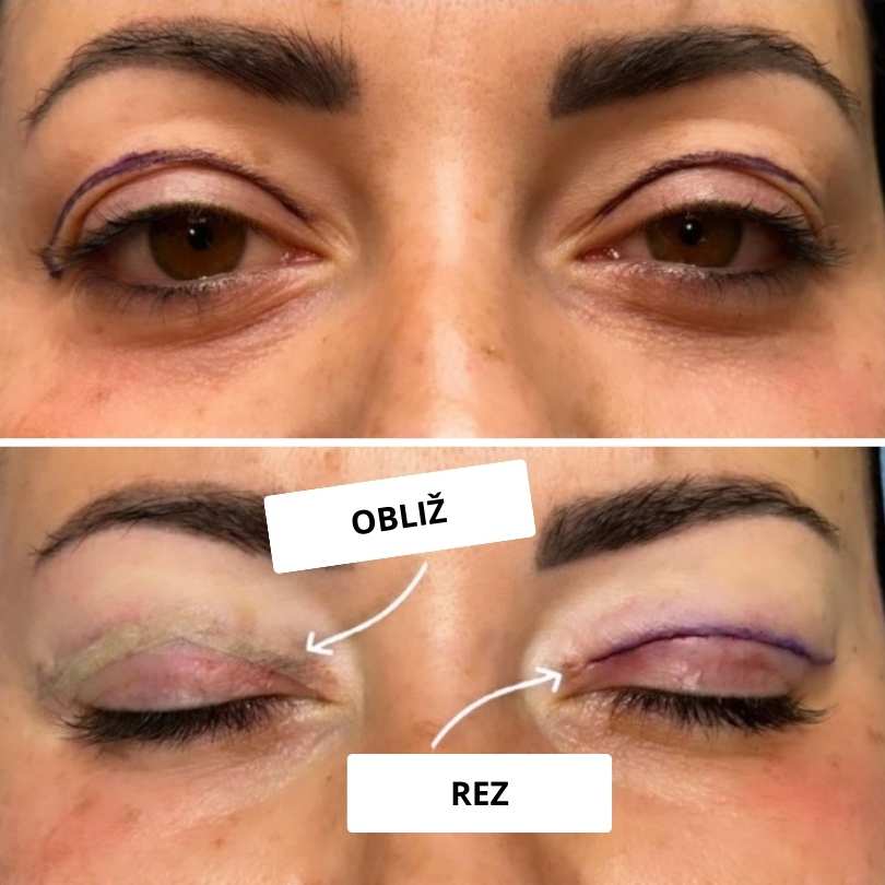 Povešene veke niso le estetska težava: Vse o blefaroplastiki