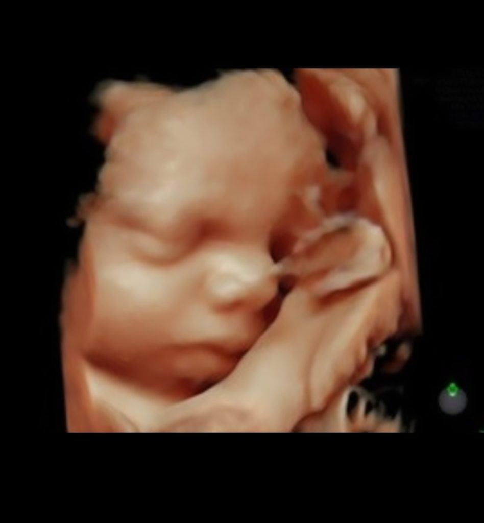 3D/4D ultrazvočni pregled v nosečnosti (2), ESTETICAL Koper