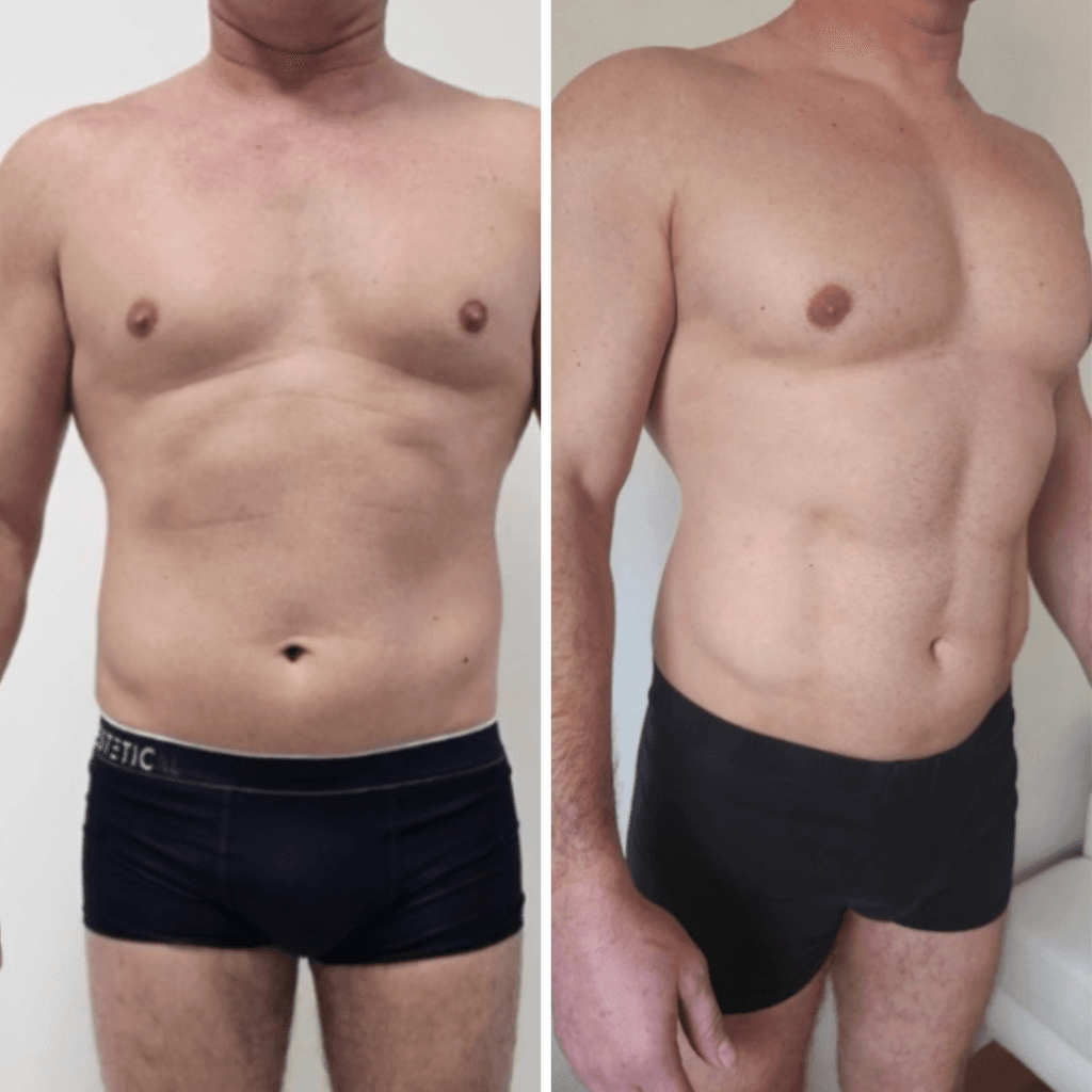 HD Liposukcija: Napredno oblikovanje telesa za izklesano postavo