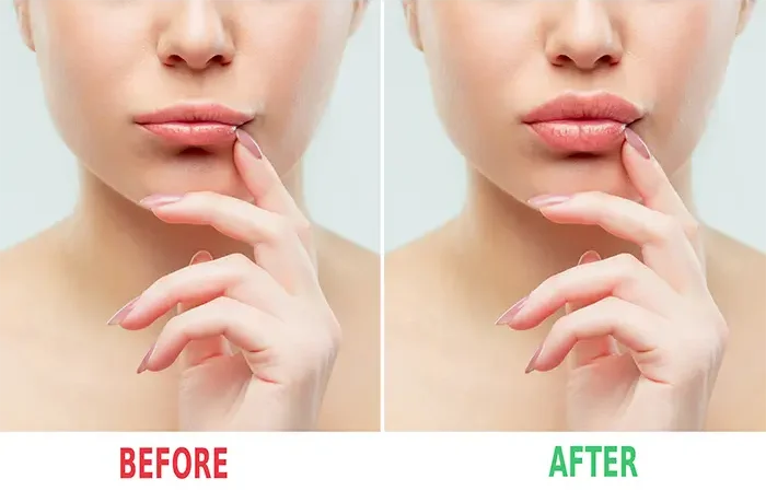 Dvig ustnice (Lip Lift)